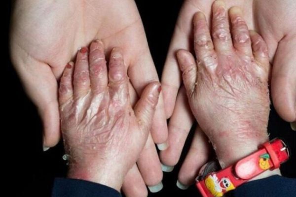 تصویری از دستان یک کودک مبتلا به بیماری پروانه‌ای